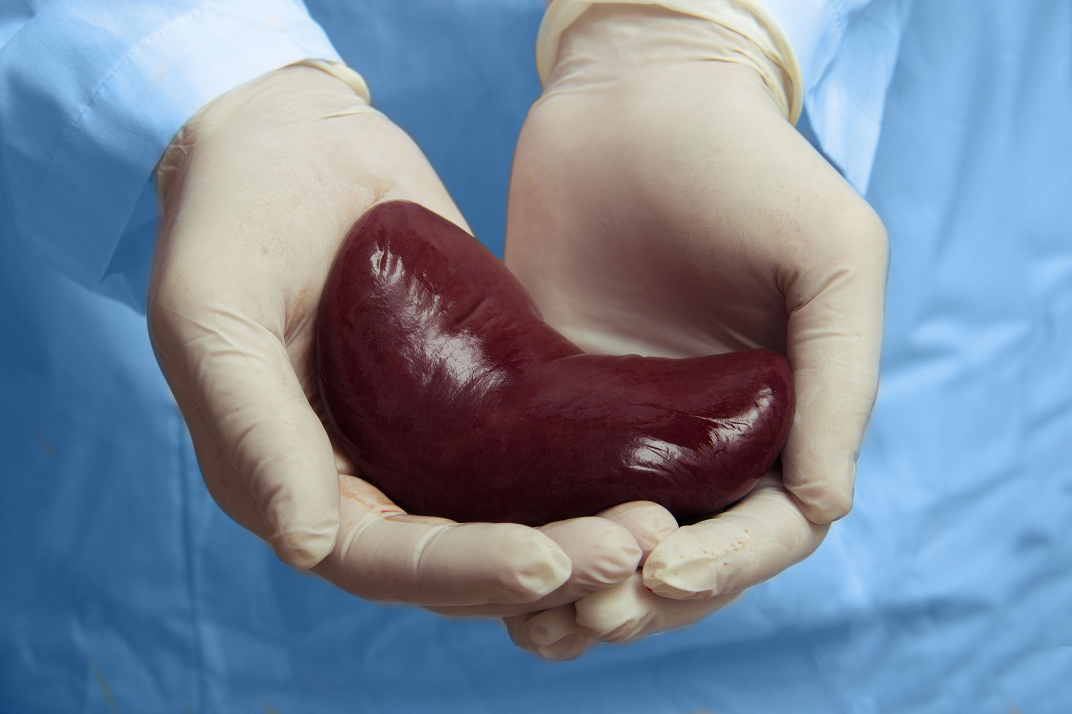 Kidney transplantation